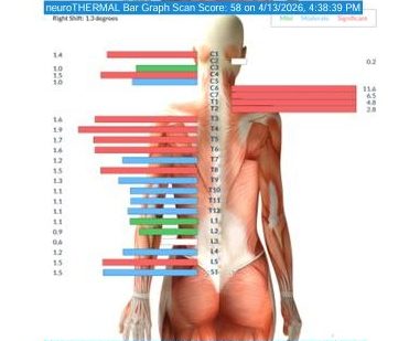 Neuro Thermal bar graph showing temperature differences at each level of the spine